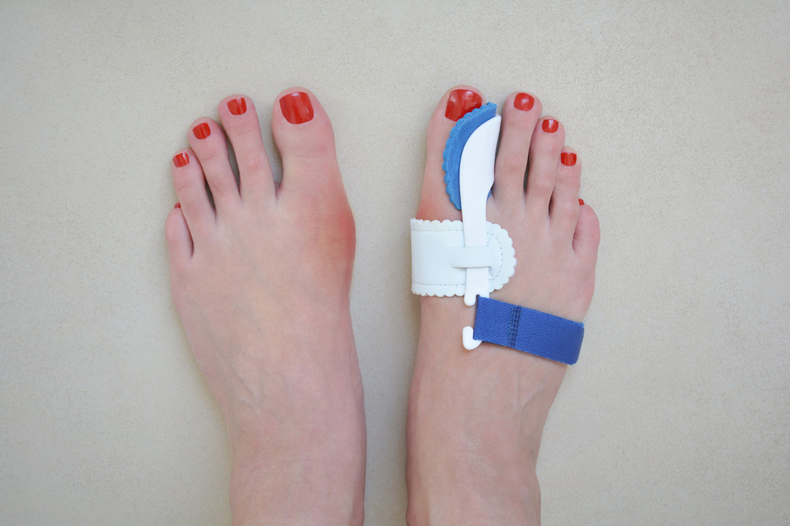 Bunion Treatment
